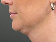 Before Ultherapy skin tightening - San Diego Dermatology and Laser Surgery